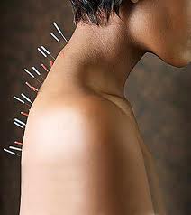 Acupuncture and Oriental Medicine
