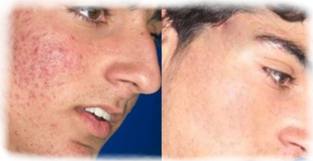 3 Easy Ways to Treat Body Acne!