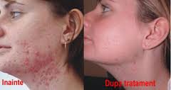 A Natural Approach To Managing Acne