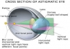 An Introduction to Astigmatism