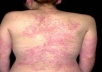 Allergic Rashes