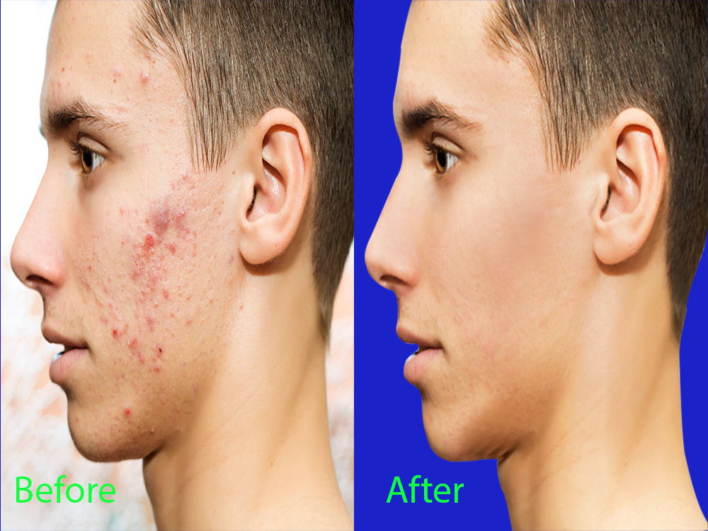 I will professional portrait retouching acne removal and beauty editing.